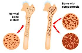 What is the full form of BMD?