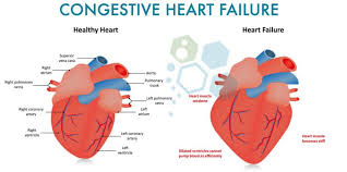 What is the full form of CHF?