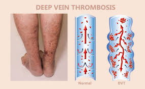 What is the full form of DVT?