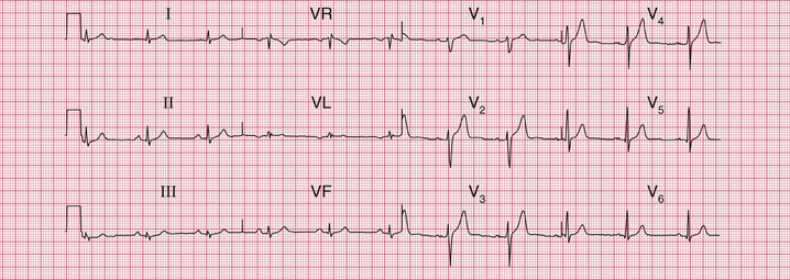 What is the full form of ECG?